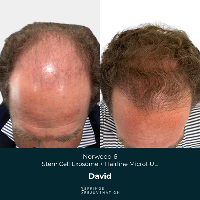 David - Before & After